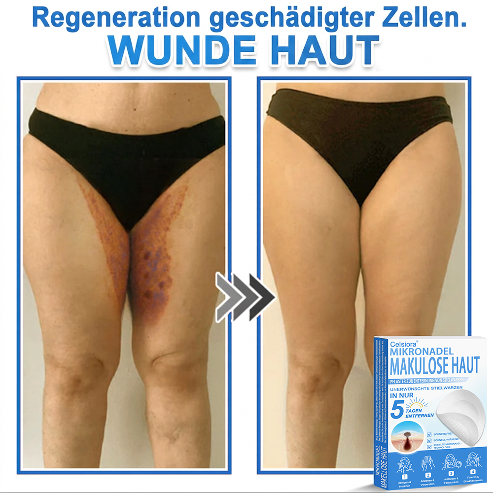 🏆Celsiora® 2-in-1 Mikronadel- & Hydrokolloid-Pflaster | Entferner für erhabene ✨✨