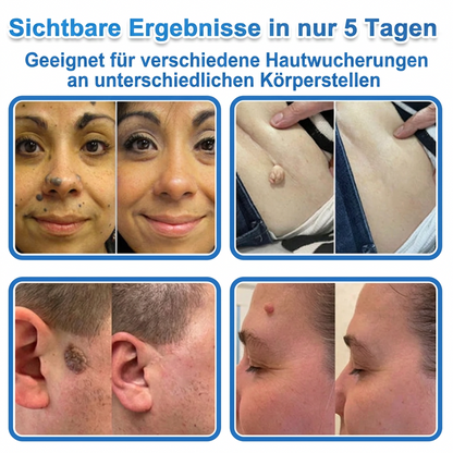 🏆Celsiora® 2-in-1 Mikronadel- & Hydrokolloid-Pflaster | Entferner für erhabene ✨✨