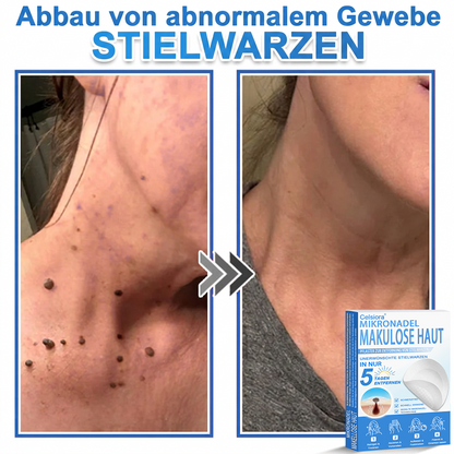 🏆Celsiora® 2-in-1 Mikronadel- & Hydrokolloid-Pflaster | Entferner für erhabene ✨✨