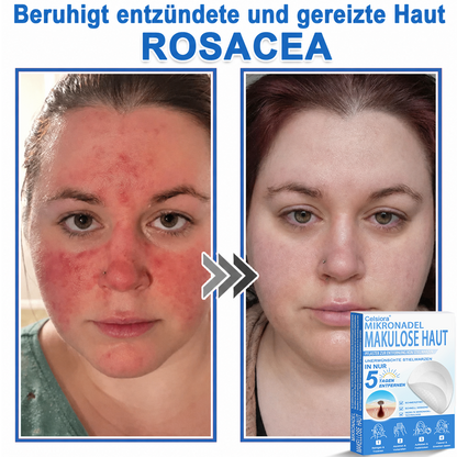 🏆Celsiora® 2-in-1 Mikronadel- & Hydrokolloid-Pflaster | Entferner für erhabene ✨✨