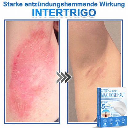 🏆Celsiora® 2-in-1 Mikronadel- & Hydrokolloid-Pflaster | Entferner für erhabene ✨✨