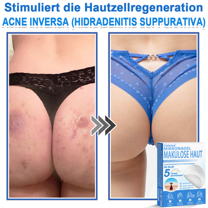 🏆Celsiora® 2-in-1 Mikronadel- & Hydrokolloid-Pflaster | Entferner für erhabene ✨✨