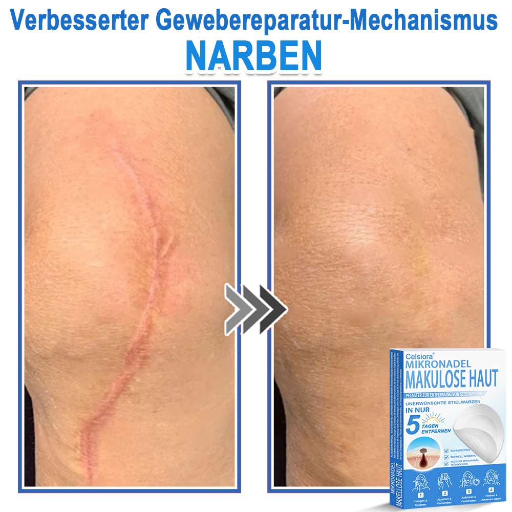 🏆Celsiora® 2-in-1 Mikronadel- & Hydrokolloid-Pflaster | Entferner für erhabene ✨✨