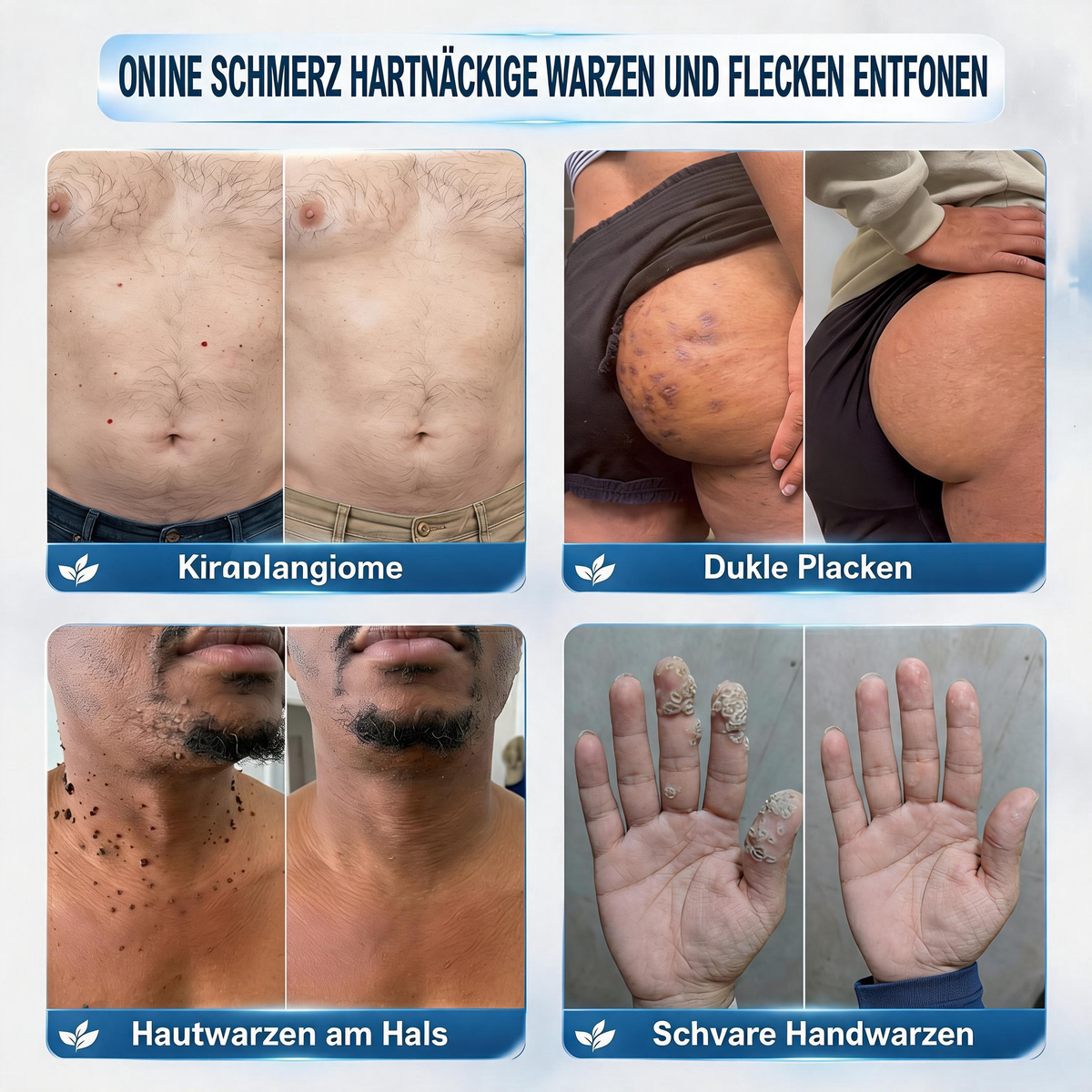 Natravor® HOHE QUALITÄTSSTANDARDS 7-Tage-Pflegekur bei Hautunregelmäßigkeiten Schmerzfrei & narbenfrei Fortschrittliche Creme zur Entfernung von Hautunreinheiten