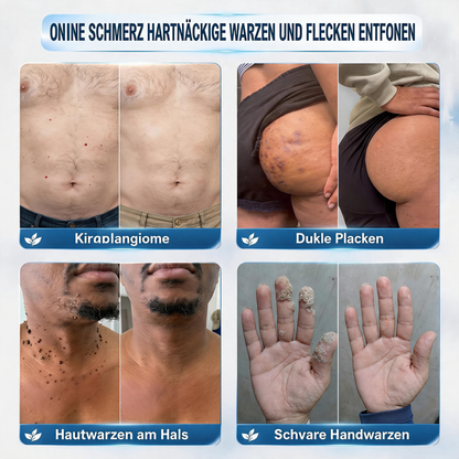 Natravor® HOHE QUALITÄTSSTANDARDS 7-Tage-Pflegekur bei Hautunregelmäßigkeiten Schmerzfrei & narbenfrei Fortschrittliche Creme zur Entfernung von Hautunreinheiten