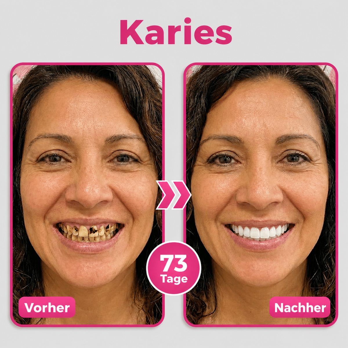 Natravor® Thismile NH-10 Zahnpasta-Serum zur Pflege von Zahnschmelz und Zahnfleisch – Fortschrittliche Therapie